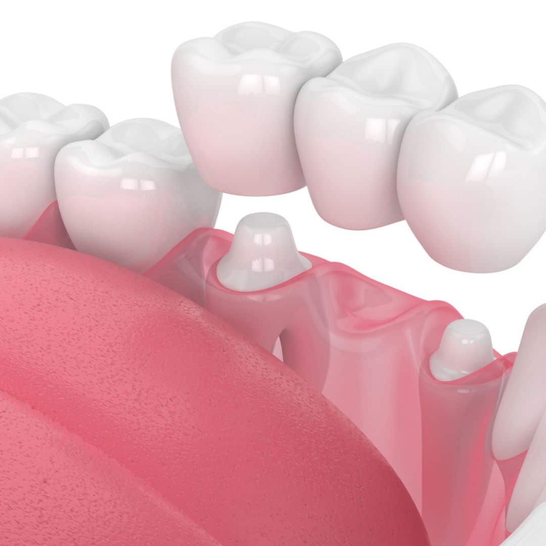 Dental Bridges Michael Alan Rolf DMD, PLLC in Alexandria, KY