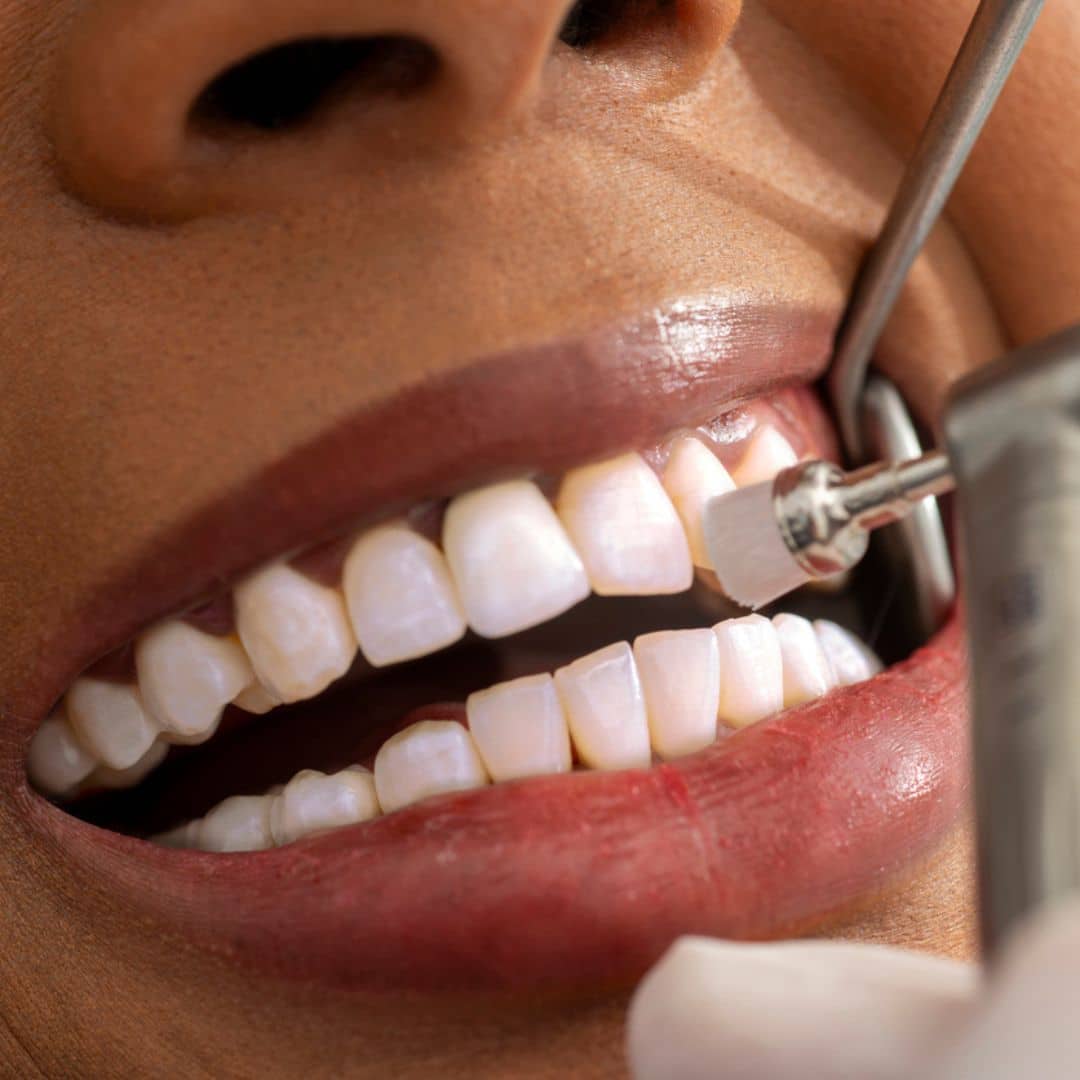 Teeth Whitening Michael Alan Rolf DMD, PLLC in Alexandria, KY