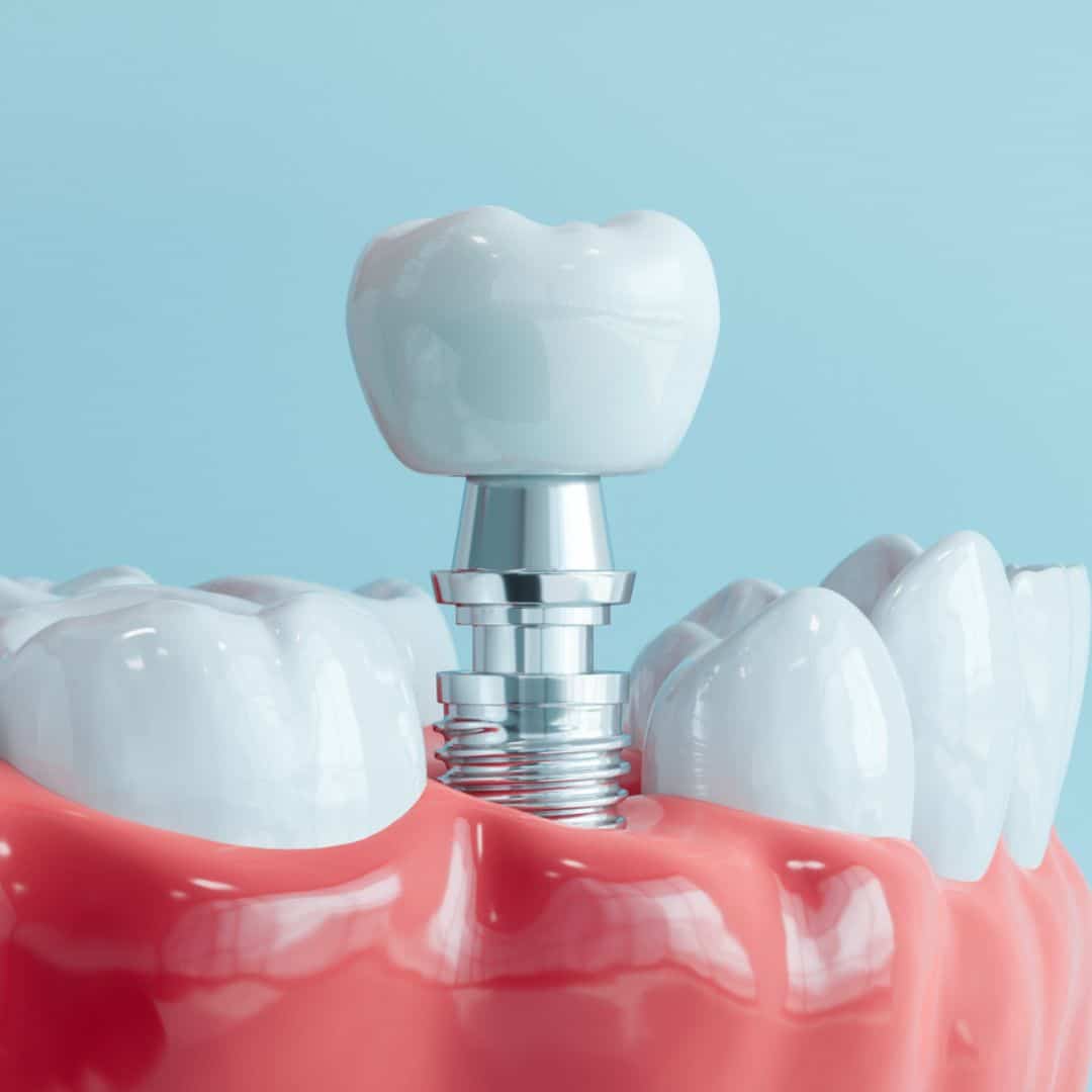Dental Implants Michael Alan Rolf DMD, PLLC in Alexandria, KY
